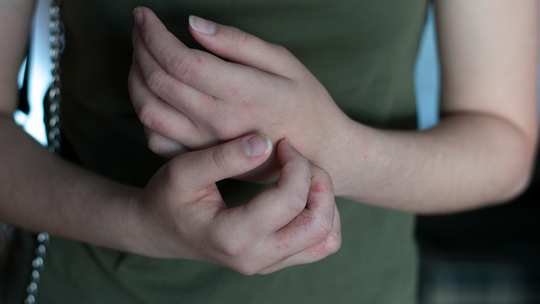 Egzema – jak objawia się u dzieci i u dorosłych?