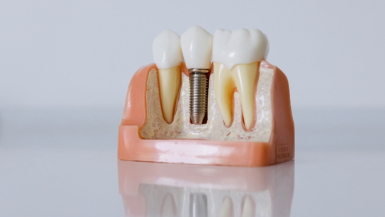 Implanty zębowe - czy warto je zrobić?