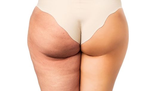 Krem na rozstępy – sprawdzamy co powinien mieć w składzie