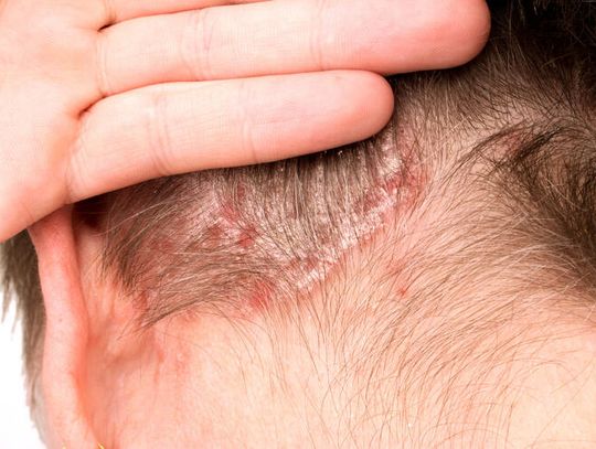 Szampon Psorisel Verdelove – delikatny, ale skuteczny w walce z łuszczycą